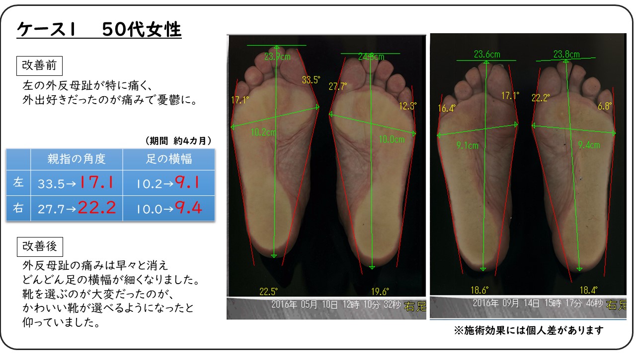 外反母趾と歩き方の関係とは どんな歩き方だと外反母趾になるのか 外反母趾を治す