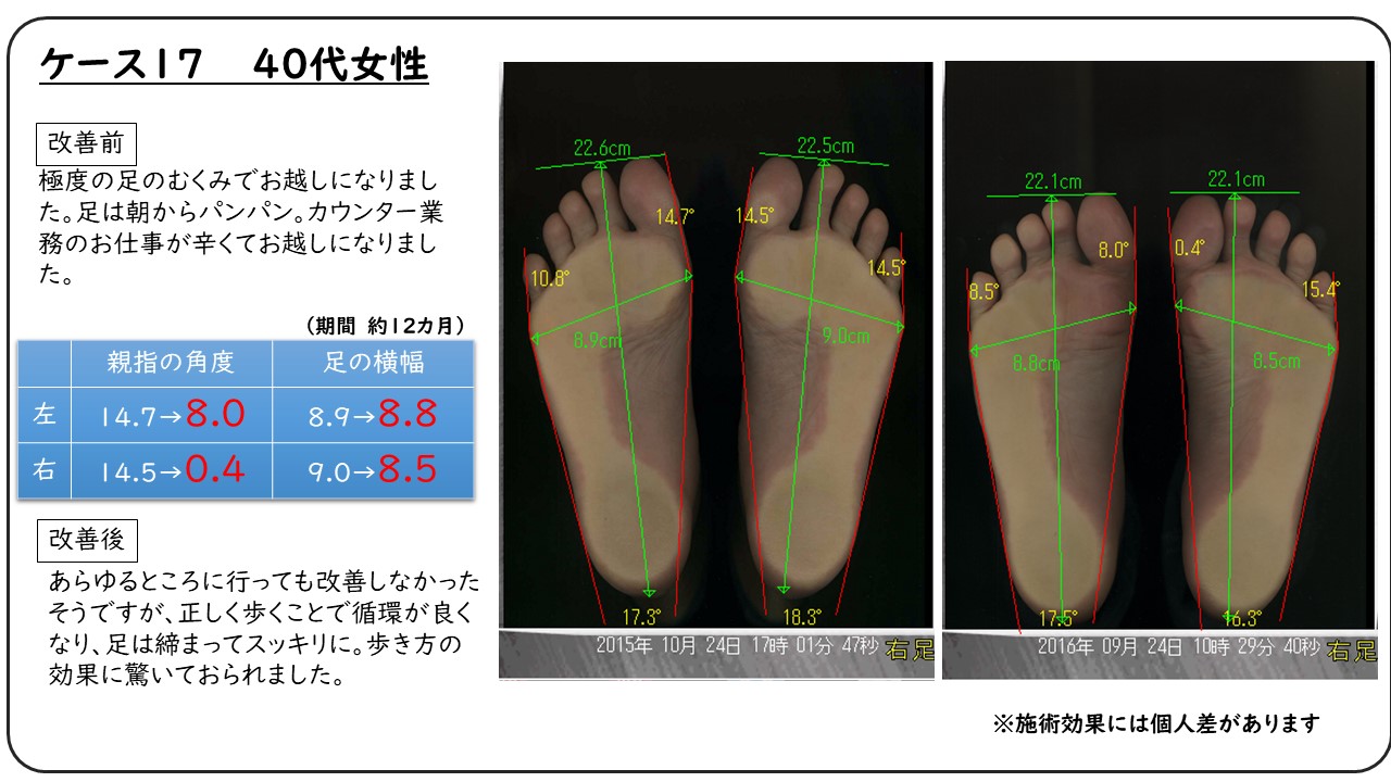 改善例集 外反母趾を始めとした足の専門院 改善例集 外反母趾を始めとした足の専門院
