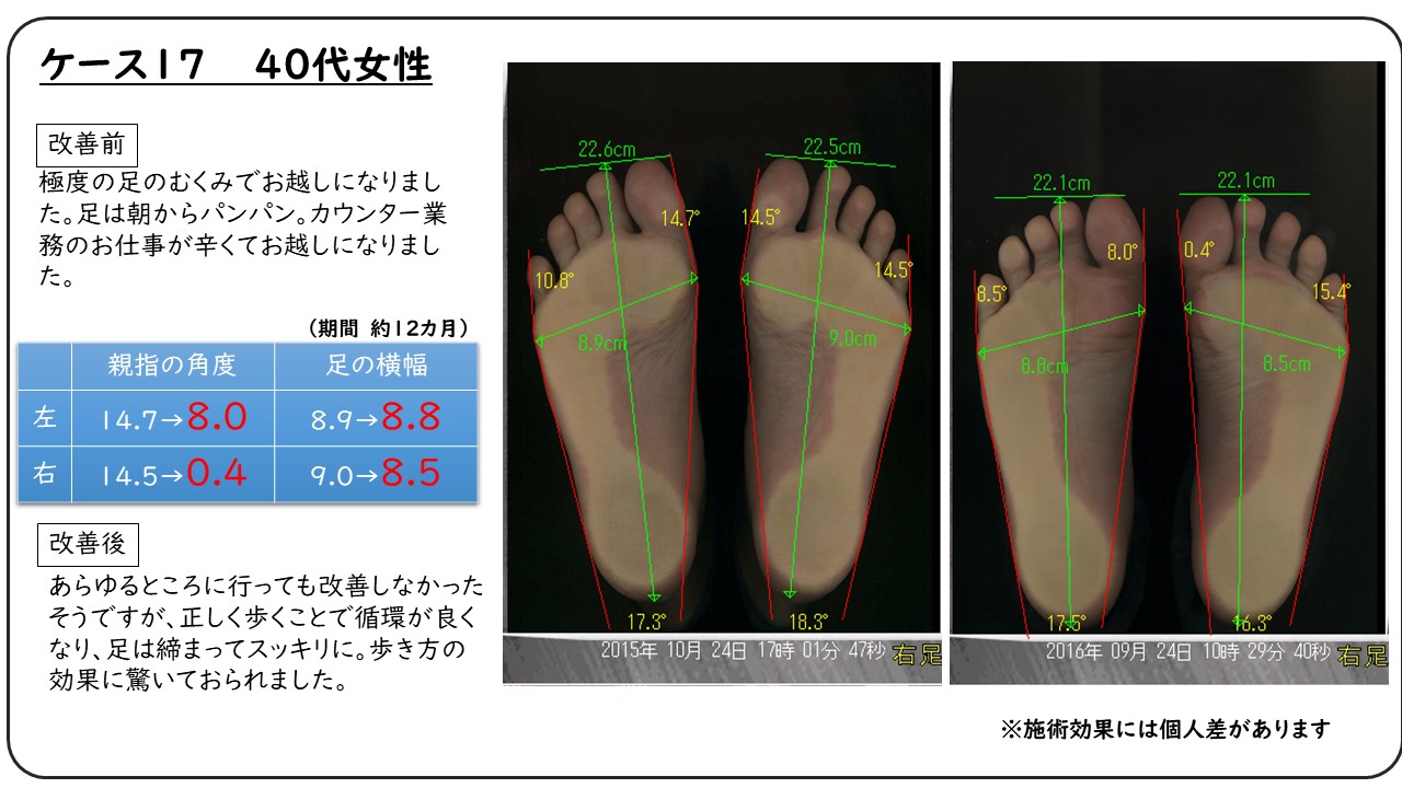 改善例集 外反母趾を始めとした足の専門院