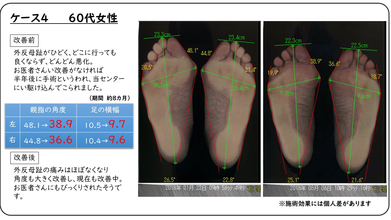 内反小趾の治療法とは 効果的な矯正法はあるのか 外反母趾を治す