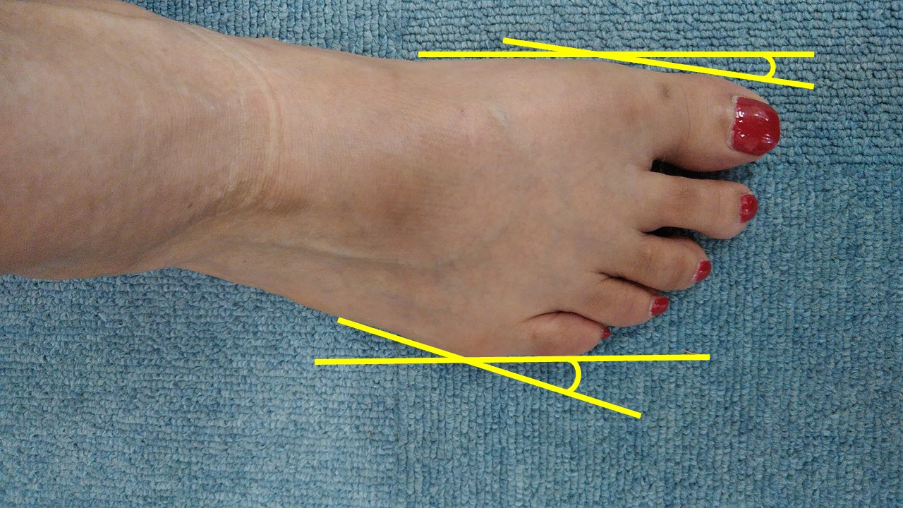 内反小趾の治療法とは 効果的な矯正法はあるのか 外反母趾を治す
