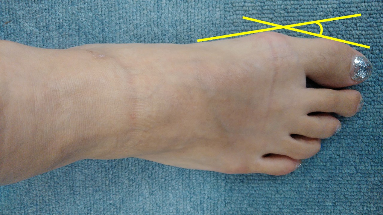 外反母趾を画像で詳細解説 あなたの状態が目で見比べてわかる 外反母趾を治す 外反母趾を画像で詳細解説 あなたの状態が目で見比べてわかる 外反母趾を治す