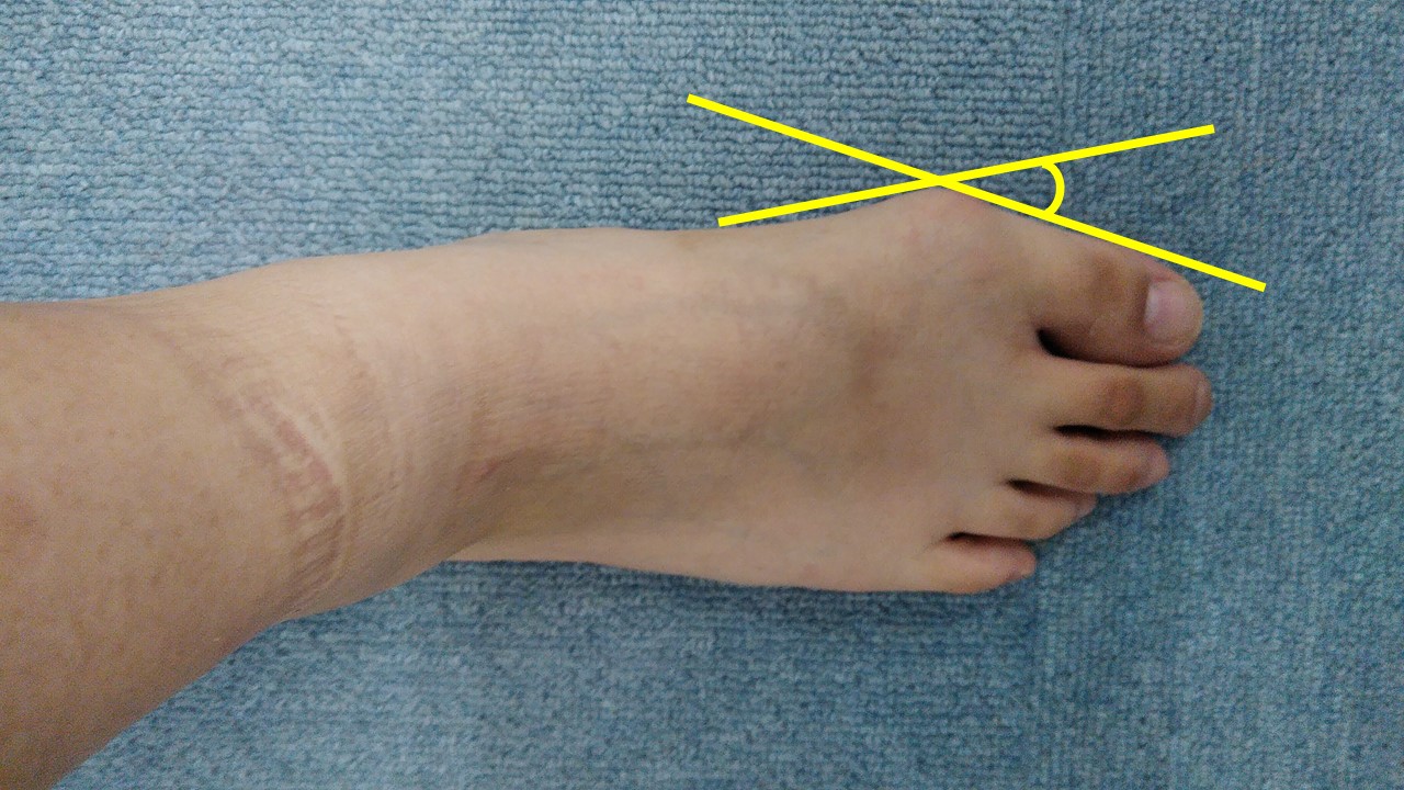 外反母趾を画像で詳細解説 あなたの状態が目で見比べてわかる 外反母趾を治す